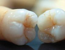 正常成年人有多少颗牙齿？