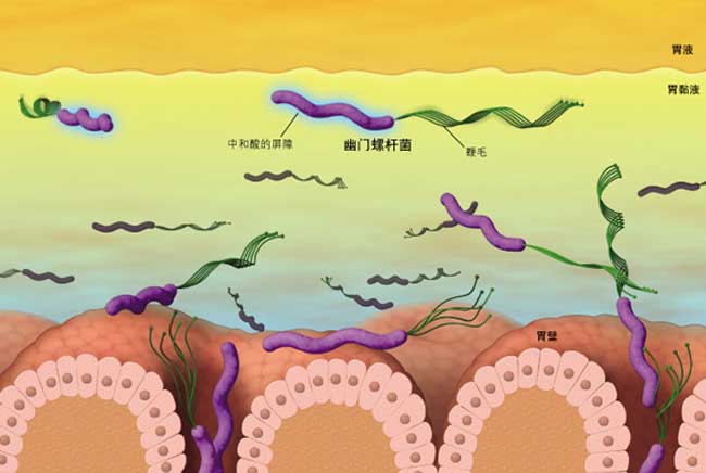 幽门螺旋杆菌绘图图片